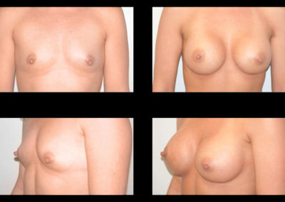 Runnels Breast Augmentation